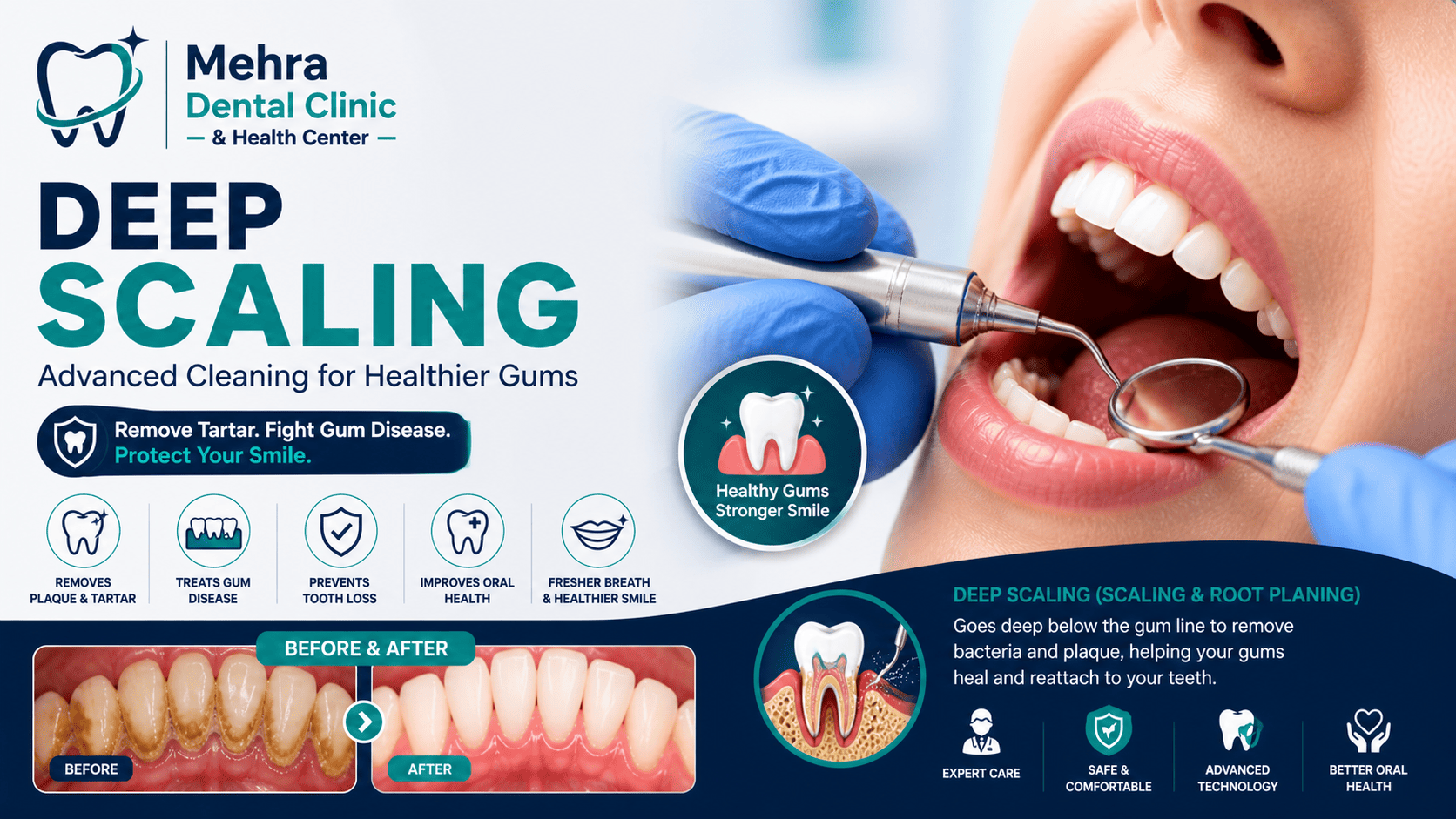 Deep Scaling: Essential Treatment for Healthy Gums & Strong Teeth